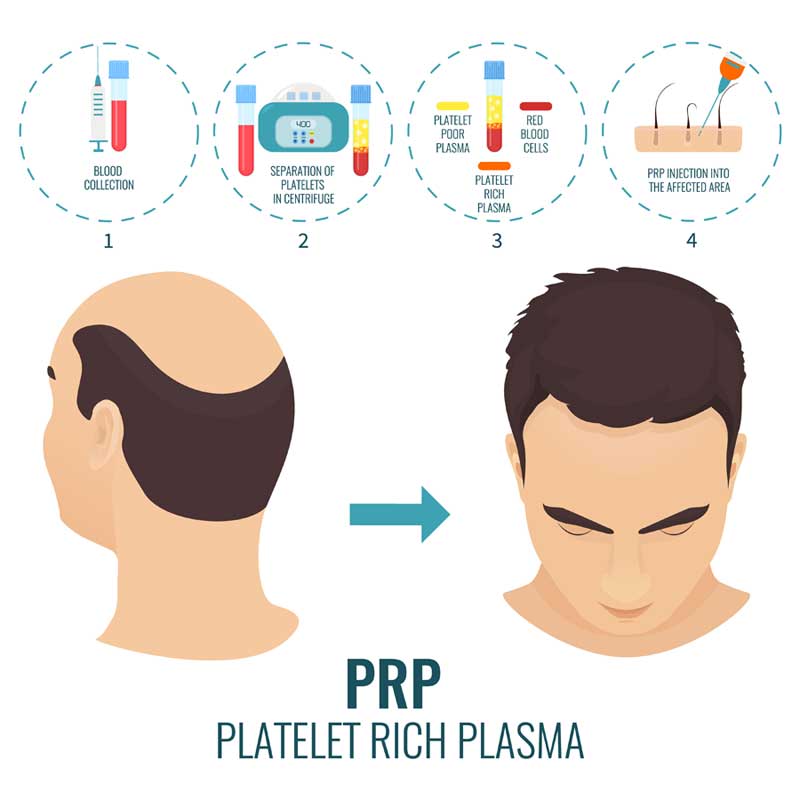 PRP - Hair Restoration - Phoenix Medical Spa